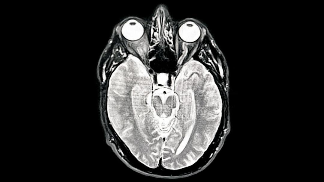 New Drug Shows Promise in Treating Alzheimer’s Disease