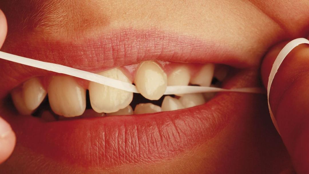 Study: Scientists Develop Dental Floss Vaccine Delivery Method