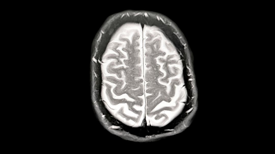 Study: Menopause Linked to Brain Gray Matter Loss