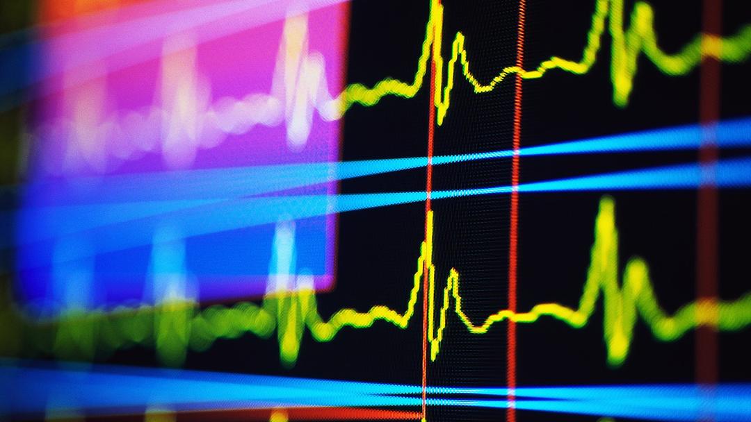 Study: AI ECG Model Shown to Predict Sudden Cardiac Death Risk