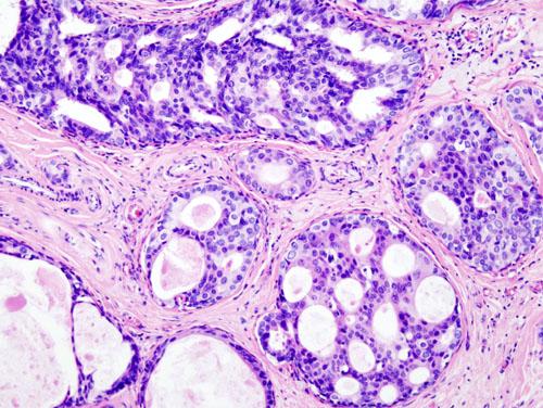 UK Study: Breast Cancer Mortality Rate Down 66%
